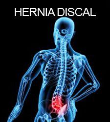 Gráfico de la columna vertebral al estilo de una radiografía, con la zona lumbar resaltada en rojo y el texto «HERNIA DISCAL»