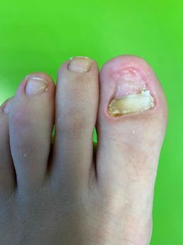 deformierter Fussnagel