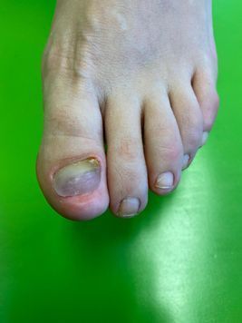 deformierterZehennagel