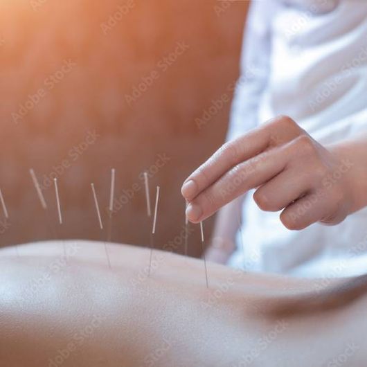 Akupunkturbehandlung