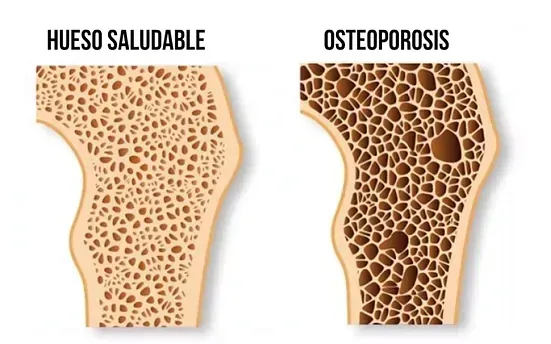 Diagrama de un hueso sano y un hueso con osteoporosis.