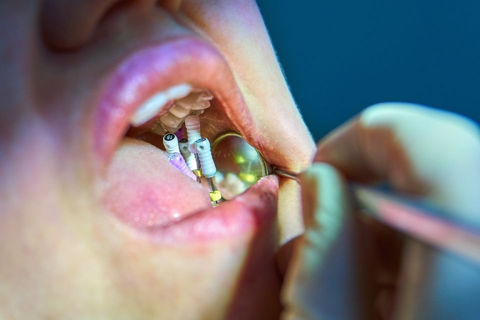 Zahnarzt untersucht Zahnimplantate im Mund eines Patienten mit einem Spiegel und Werkzeugen.