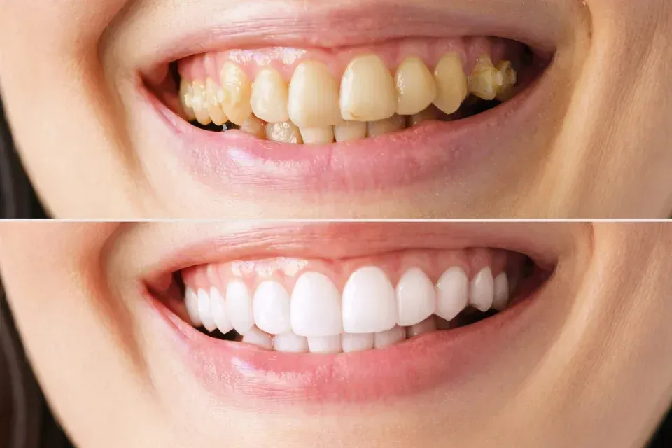 Primer plano del antes y el después del blanqueamiento dental: dientes manchados arriba, sonrisa blanca y brillante abajo.