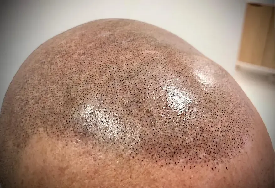 Un primer plano de la cabeza calva de un hombre con mucho pelo.