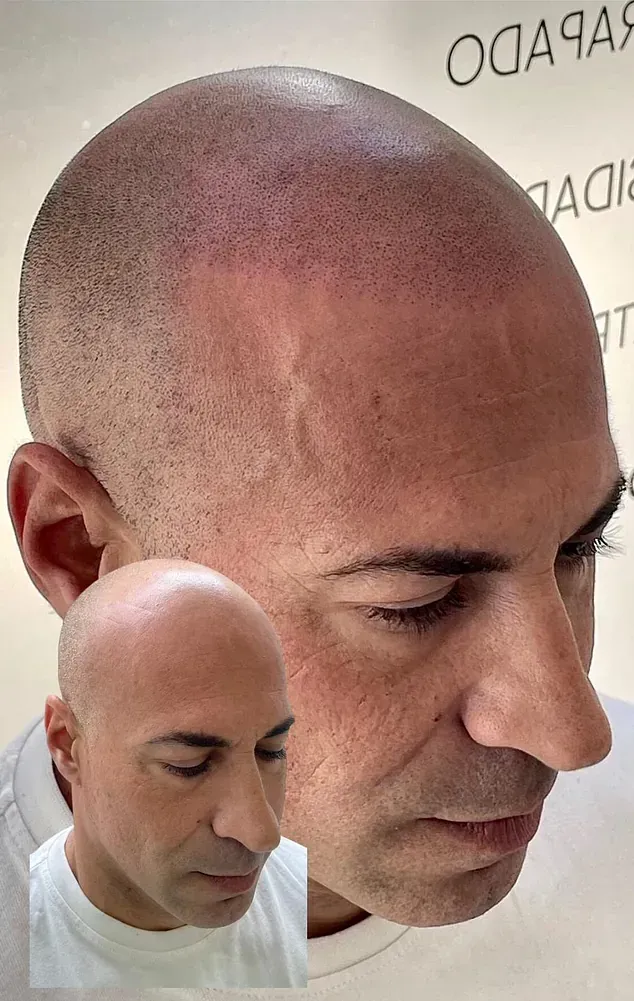 Un hombre calvo tiene un tatuaje en la frente.