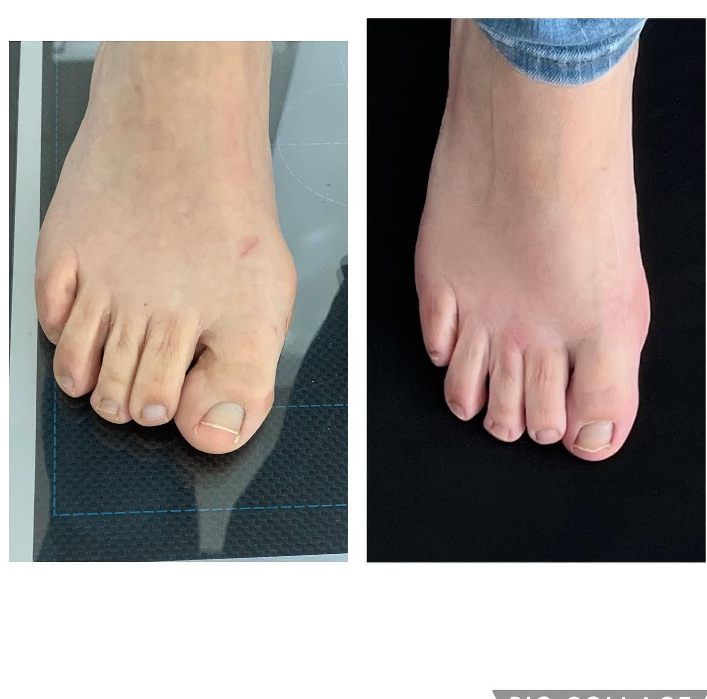 Fotografías comparativas de un pie con juanete y dedos superpuestos, una sobre una superficie oscura y otra sobre tela azul.