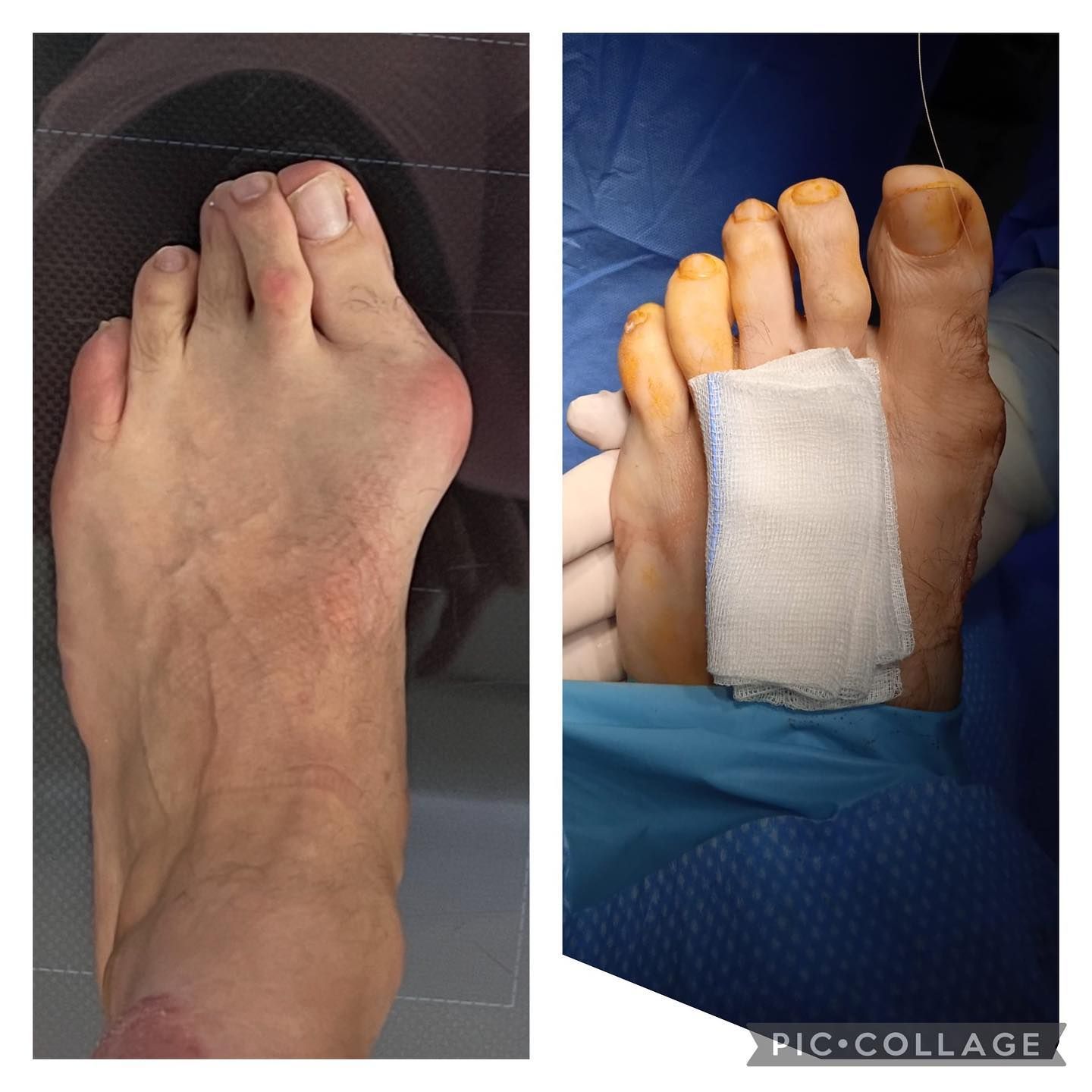 Fotografías comparativas de un pie antes y después del tratamiento, con un vendaje de gasa en el pie derecho.
