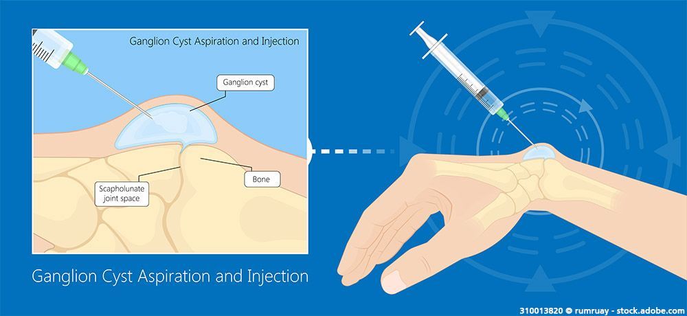 Ganglion Cyst Aspiration and Injection