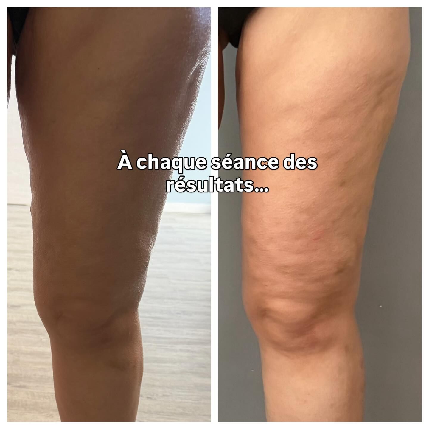 Photos avant après de jambes.