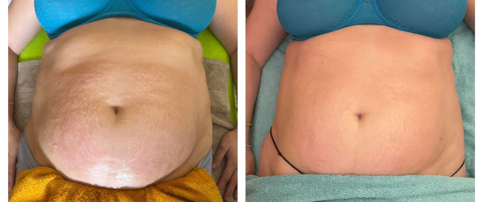 Photos avant après du ventre d'une femme allongée.