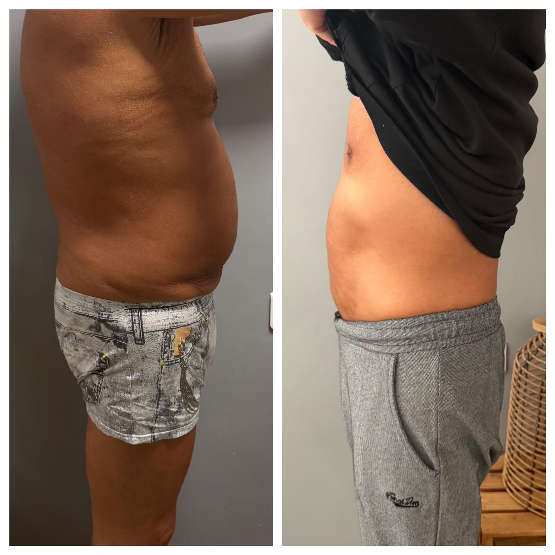 Photos avant après du ventre d'un homme.
