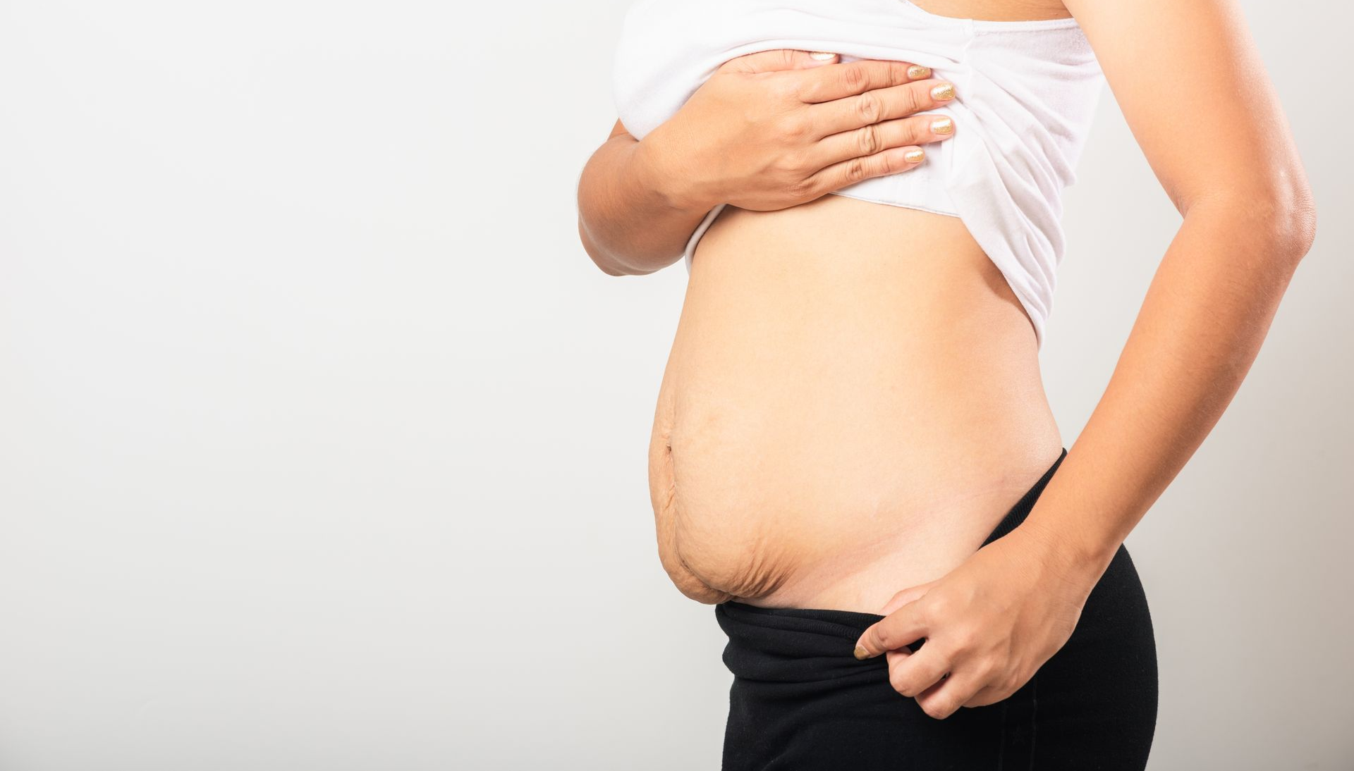 Femme montrant son ventre post-partum, avec une masse graisseuse sur la partie inférieure