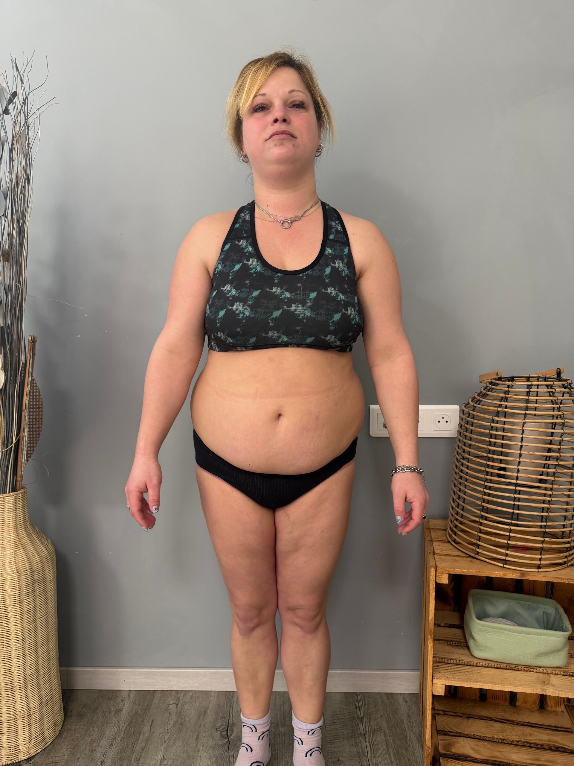 Photo de face  du ventre d'une femme après traitement.