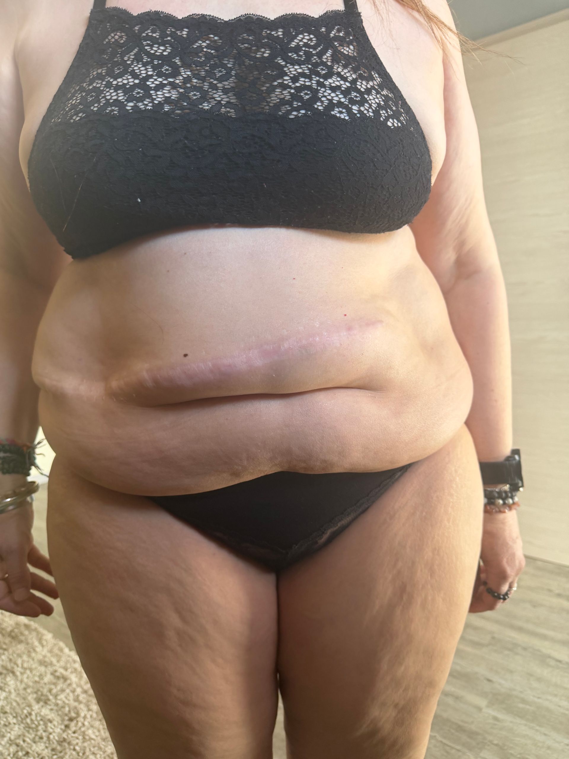 Photo de face du ventre d'une femme avant traitement.
