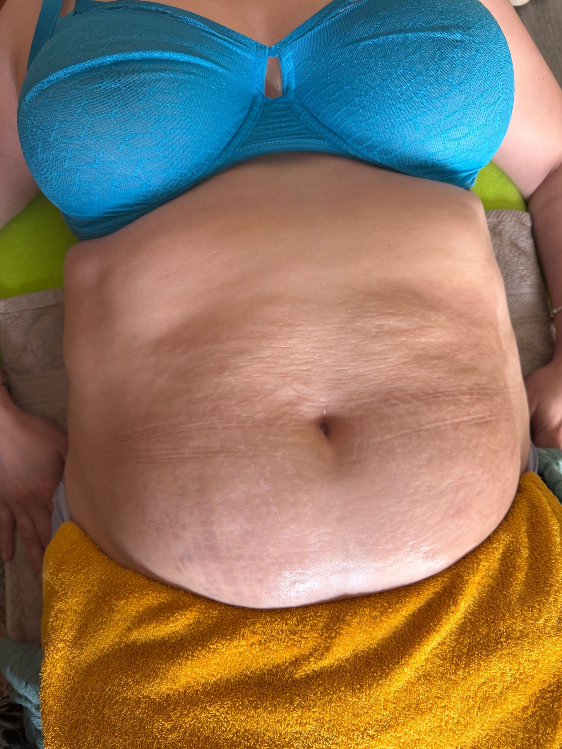 Photo du ventre d'une femme allongée de face, avant traitement.