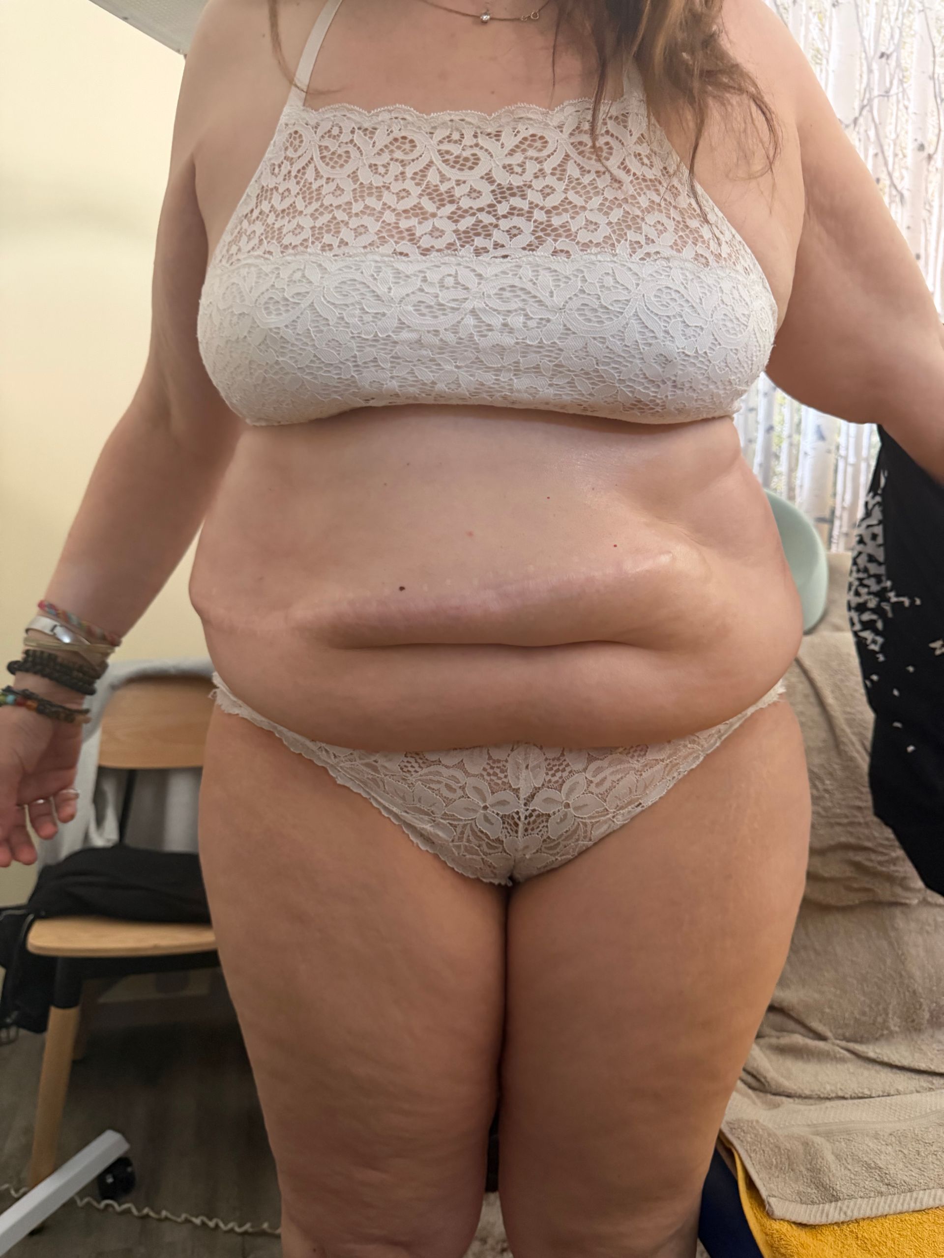 Photo d'une femme de face avant un traitement par drainage lymphatique.