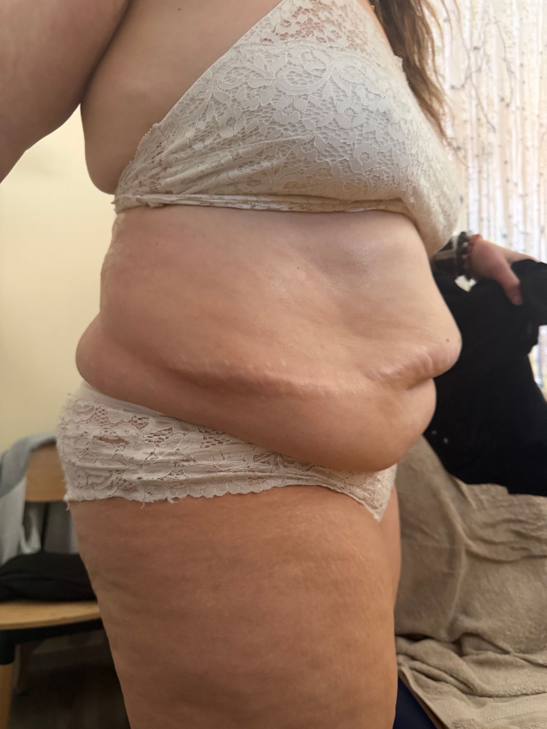 Photo d'une femme de profil avant un traitement par drainage lymphatique.