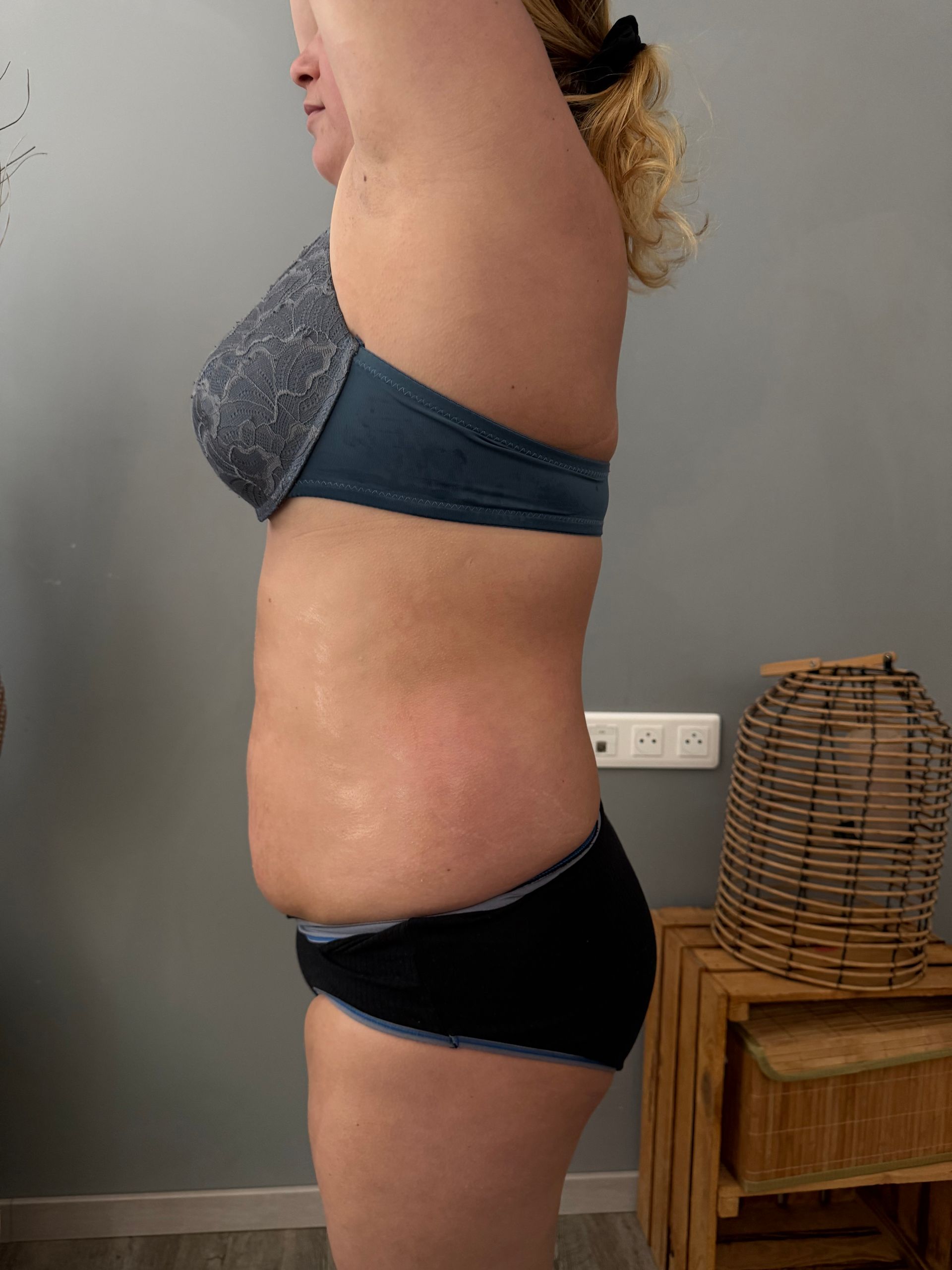 Photo du ventre d'une femme de profil après un traitement avec Révélya.
