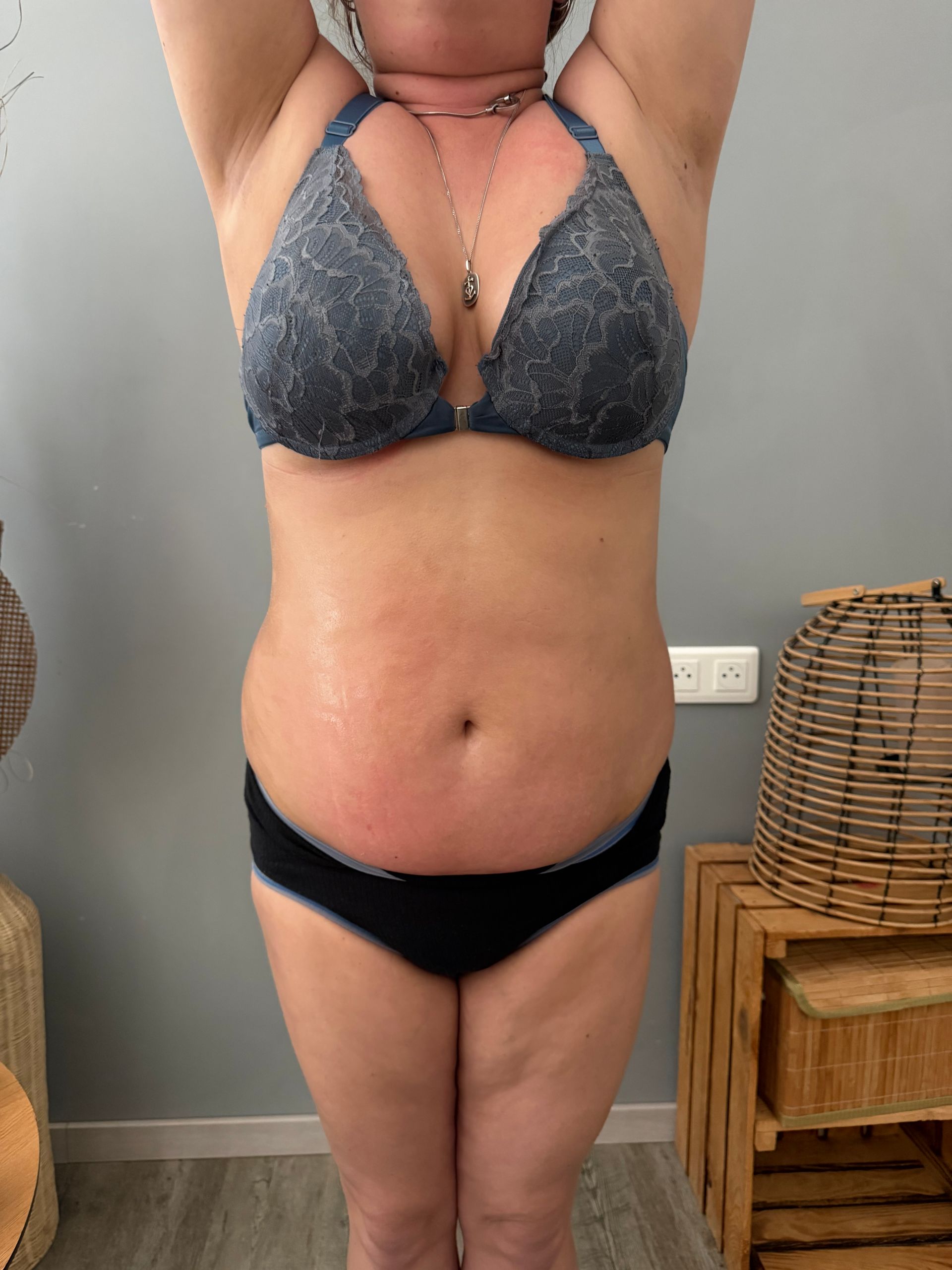 Photo du ventre d'une femme de face après un traitement avec Révélya.
