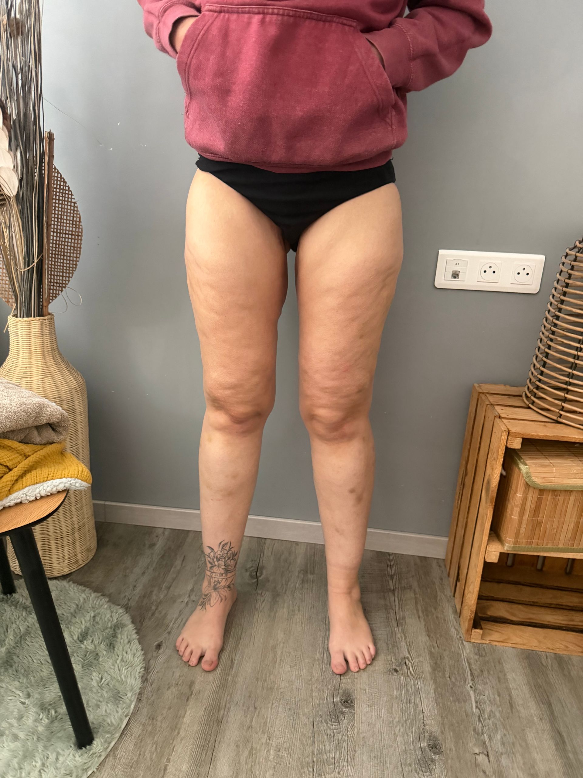 Photo de face des jambes d'une femme avant drainage lymphatique.