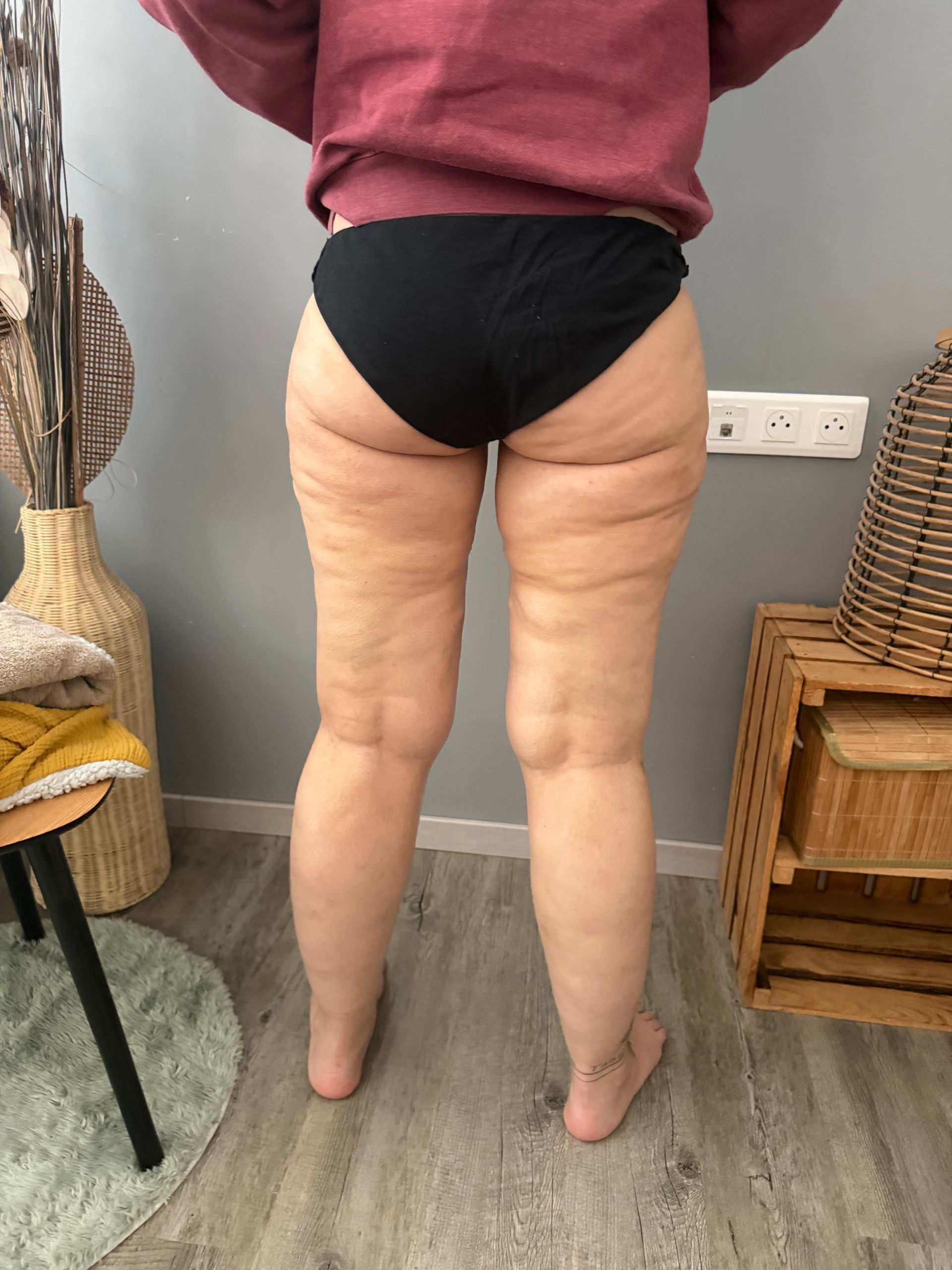 Photo de dos des jambes d'une femme avant drainage lymphatique.