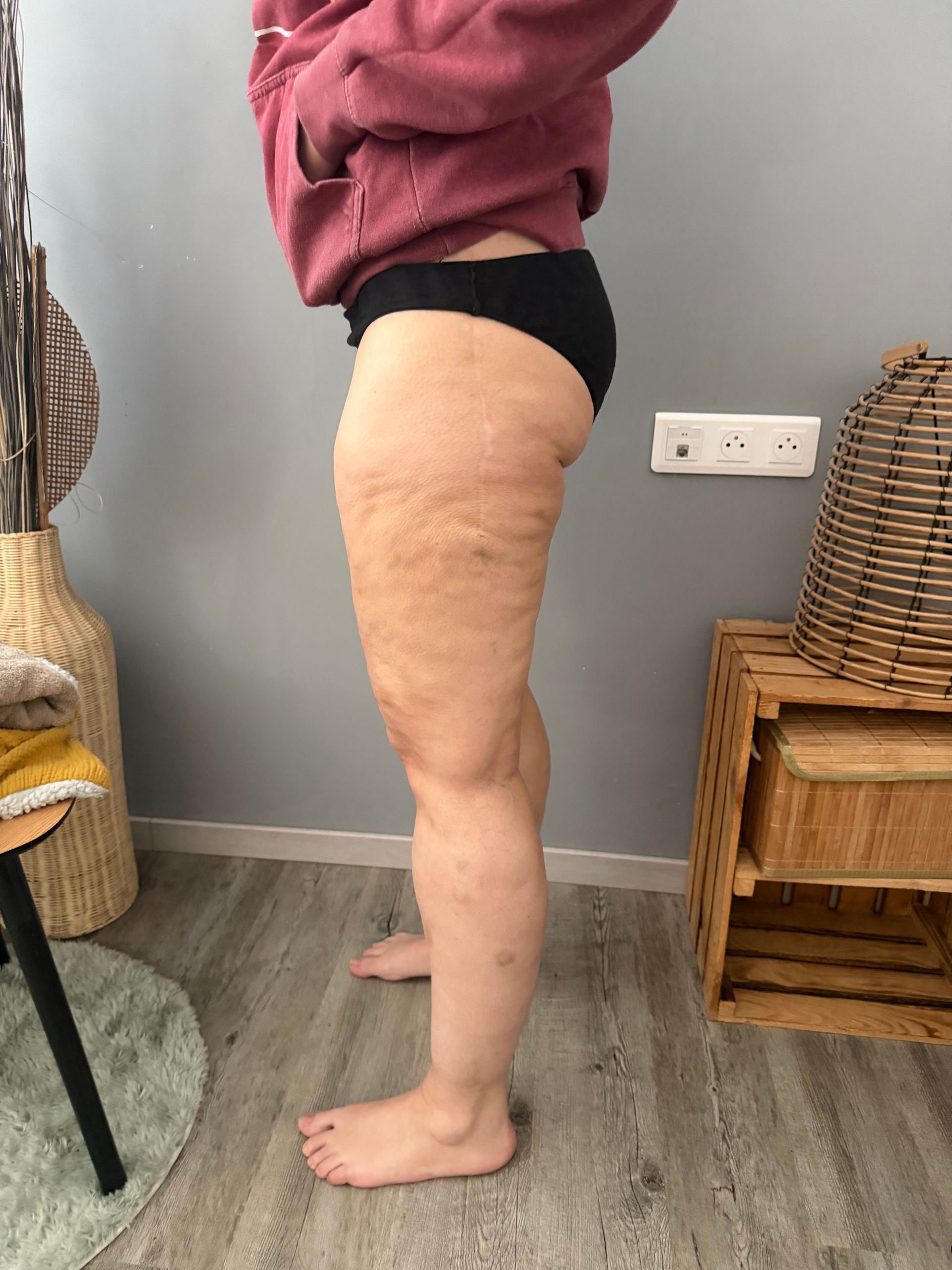 Photo de profil des jambes d'une femme avant drainage lymphatique.