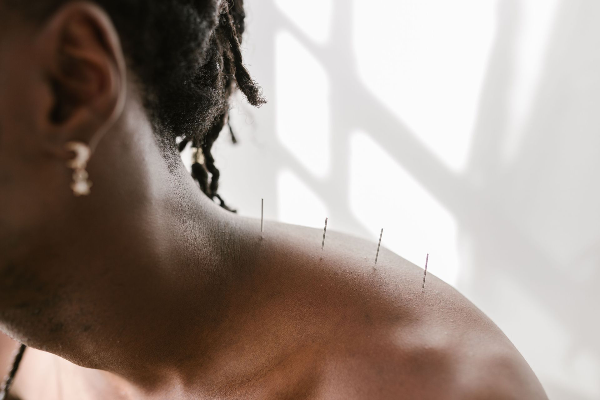 Primer plano del hombro y el cuello de una persona con agujas de acupuntura insertadas.