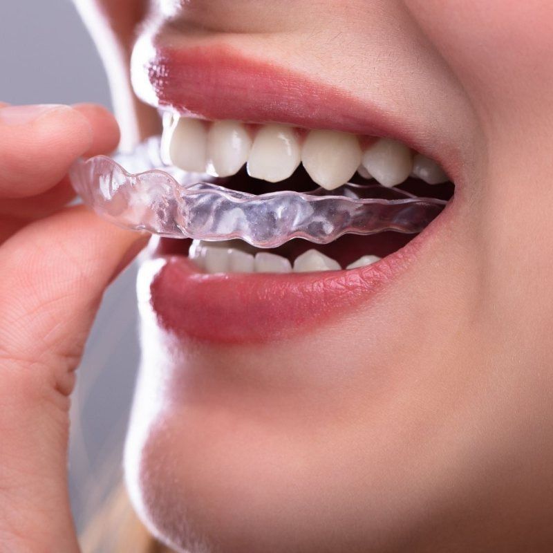 Una mujer se está colocando un retenedor transparente en los dientes.