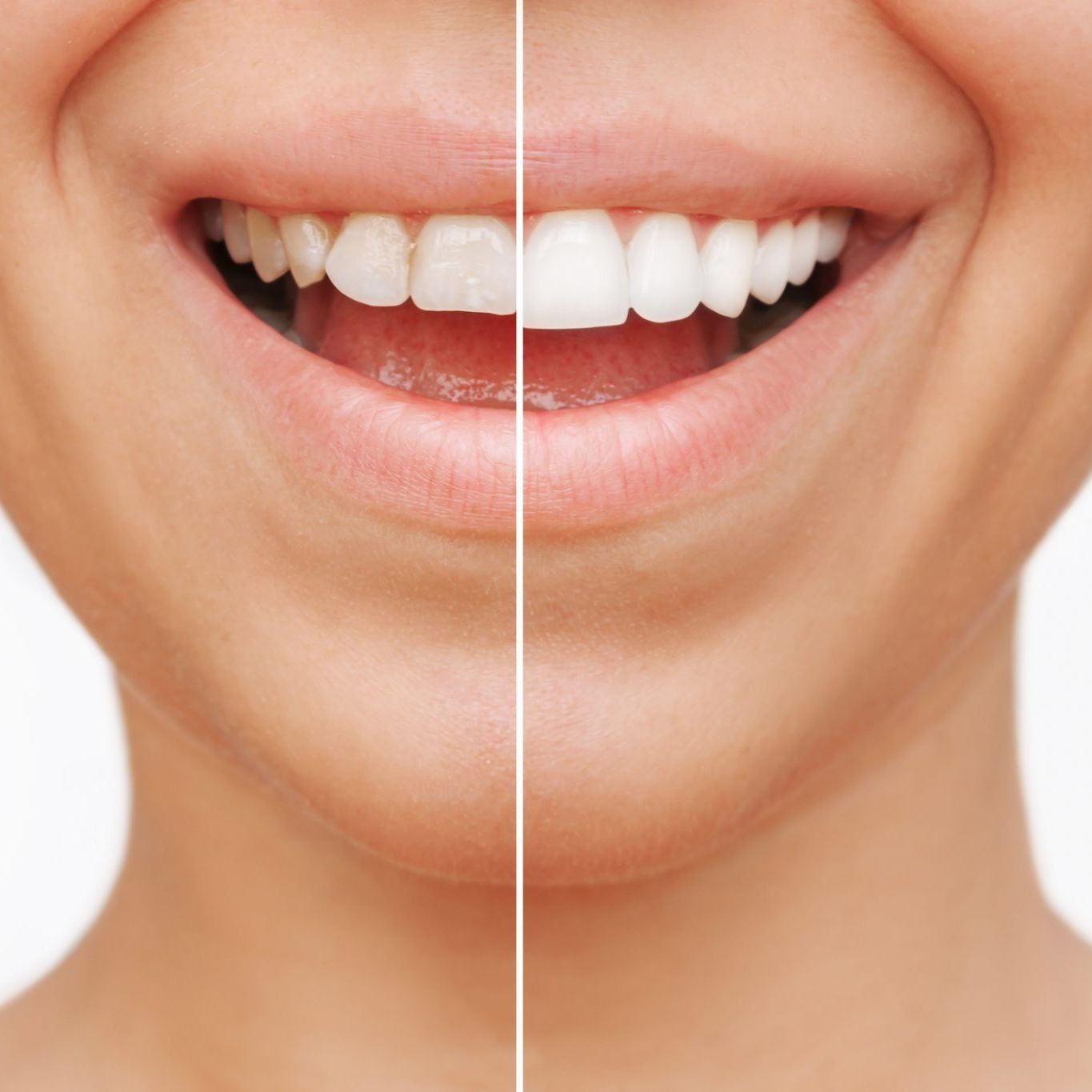 Una foto de antes y después de los dientes de una mujer.