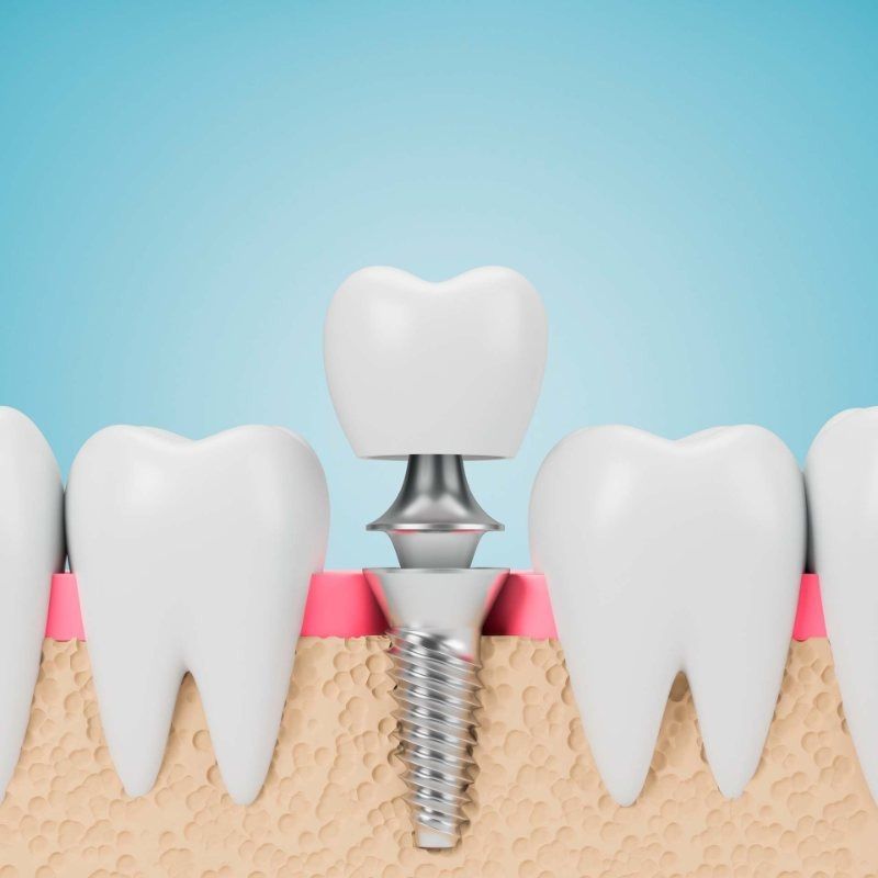 Una representación 3D de un implante dental en una fila de dientes.
