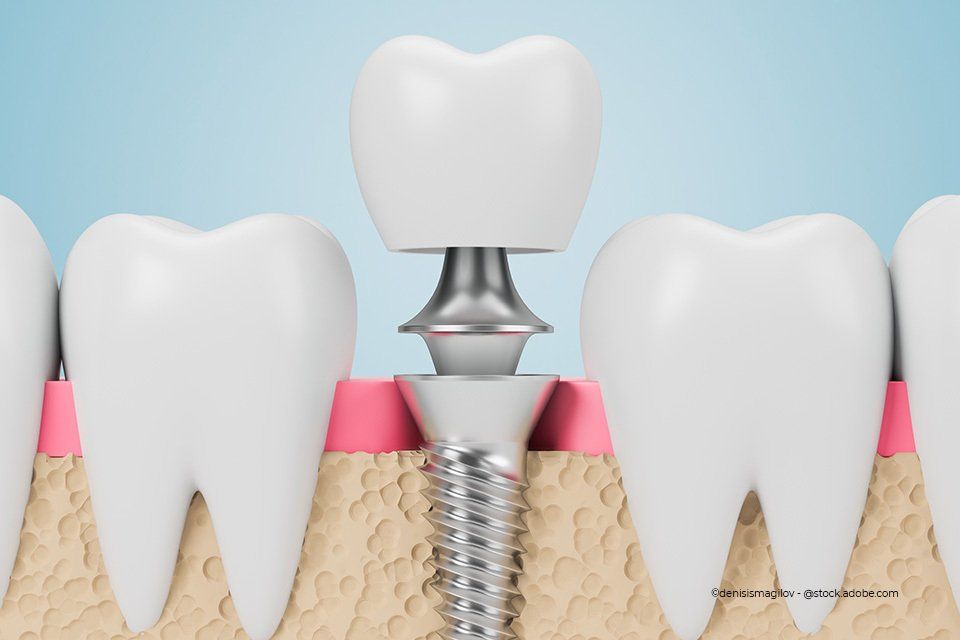Illustration vom Zahnimplantat