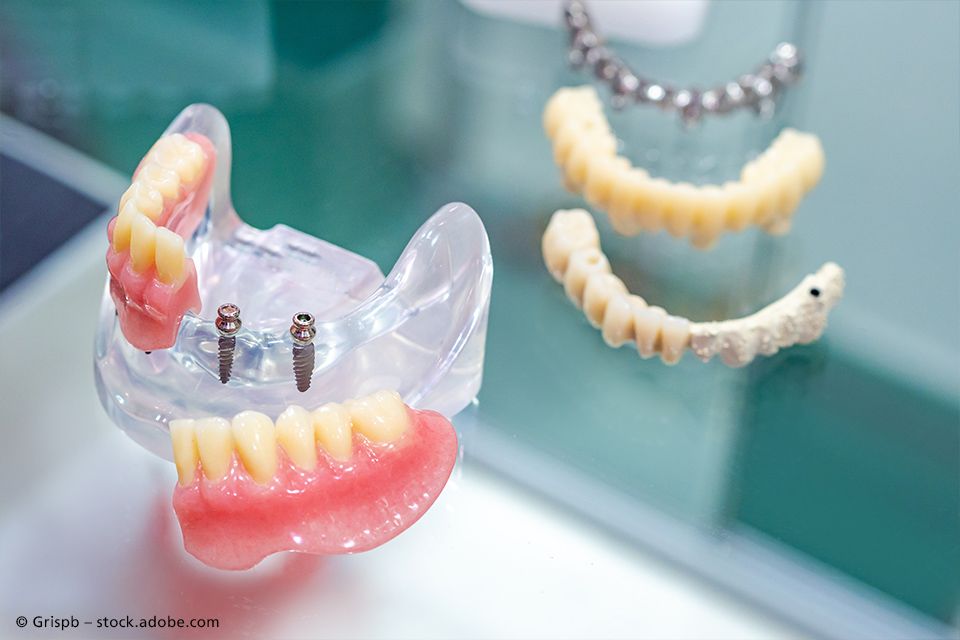 Modell vom Zahnimplantat