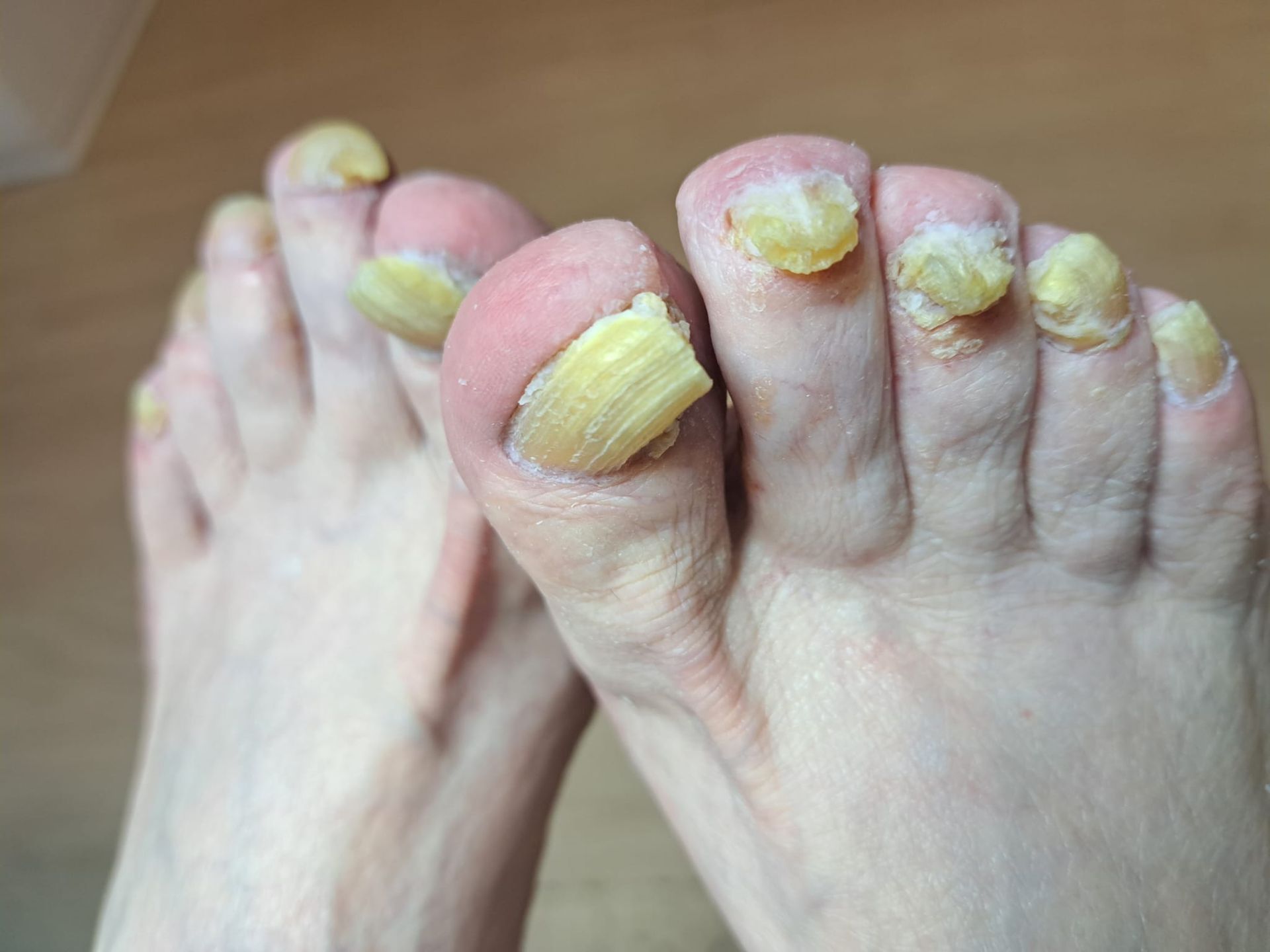 Eine Nahaufnahme der Füße einer Person mit gelben Zehennägeln.