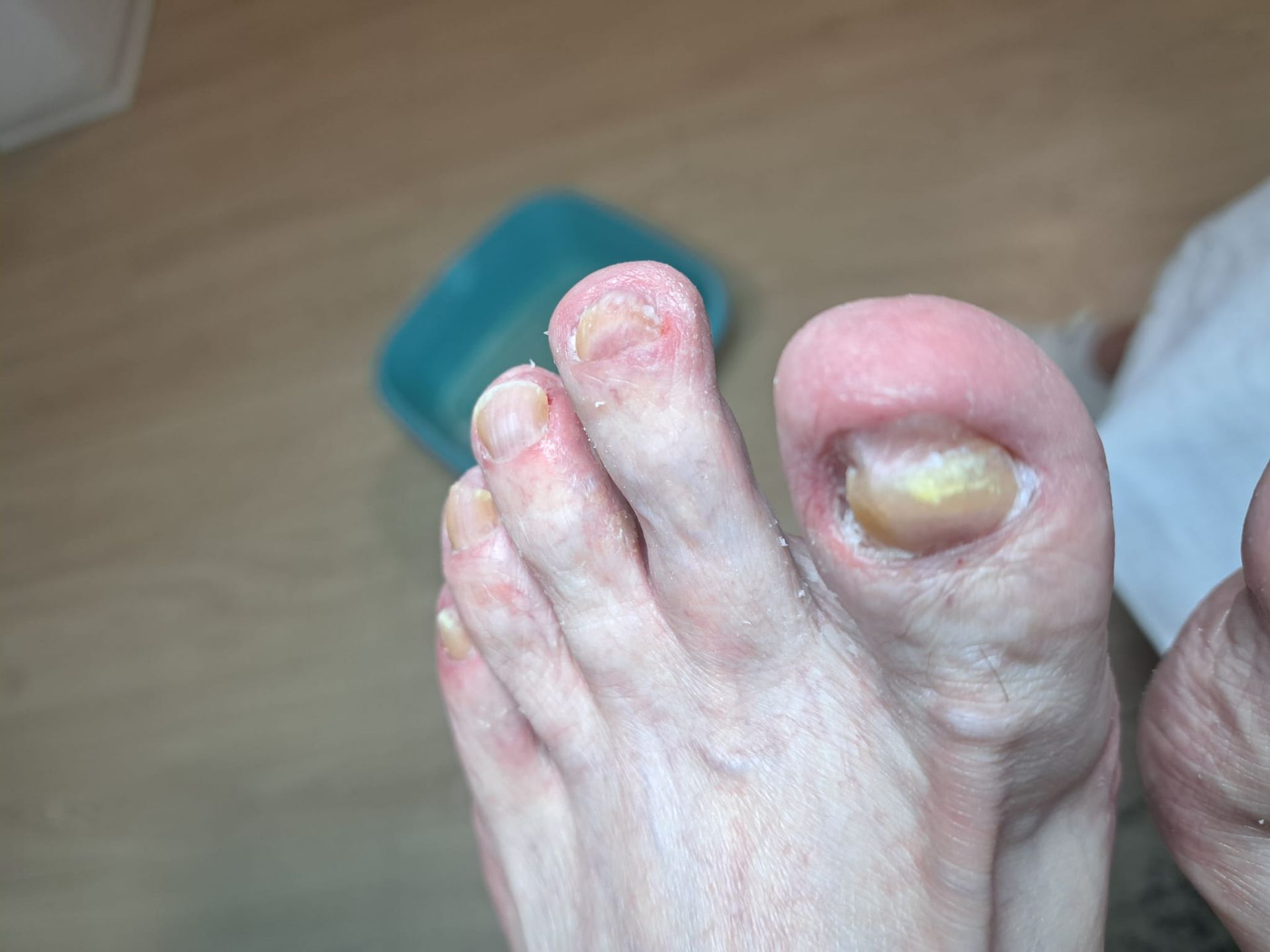 Eine Nahaufnahme vom Fuß einer Person mit einem abgebrochenen Zehennagel.