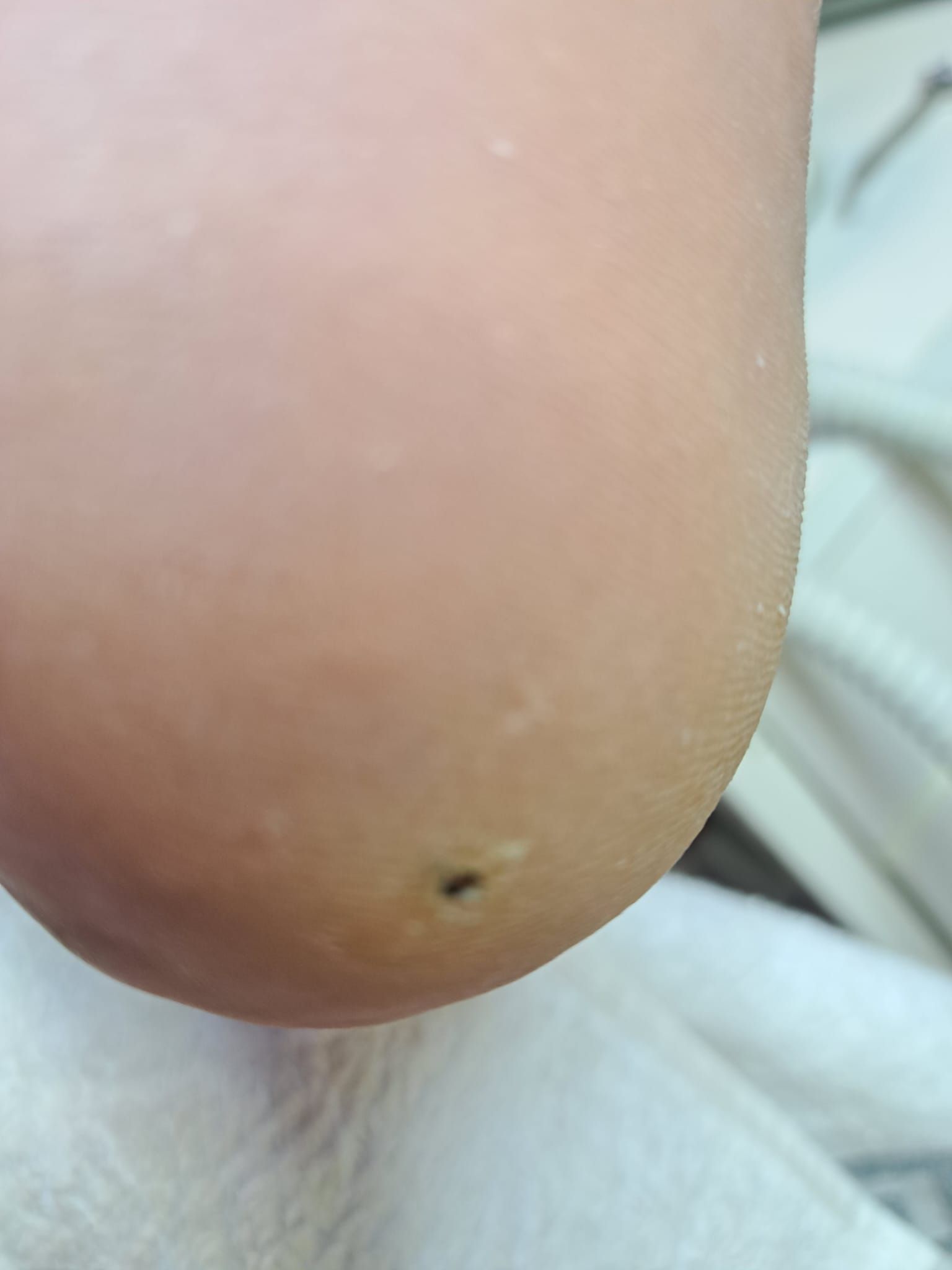 Eine Nahaufnahme vom Fuß einer Person mit einem schwarzen Fleck darauf.