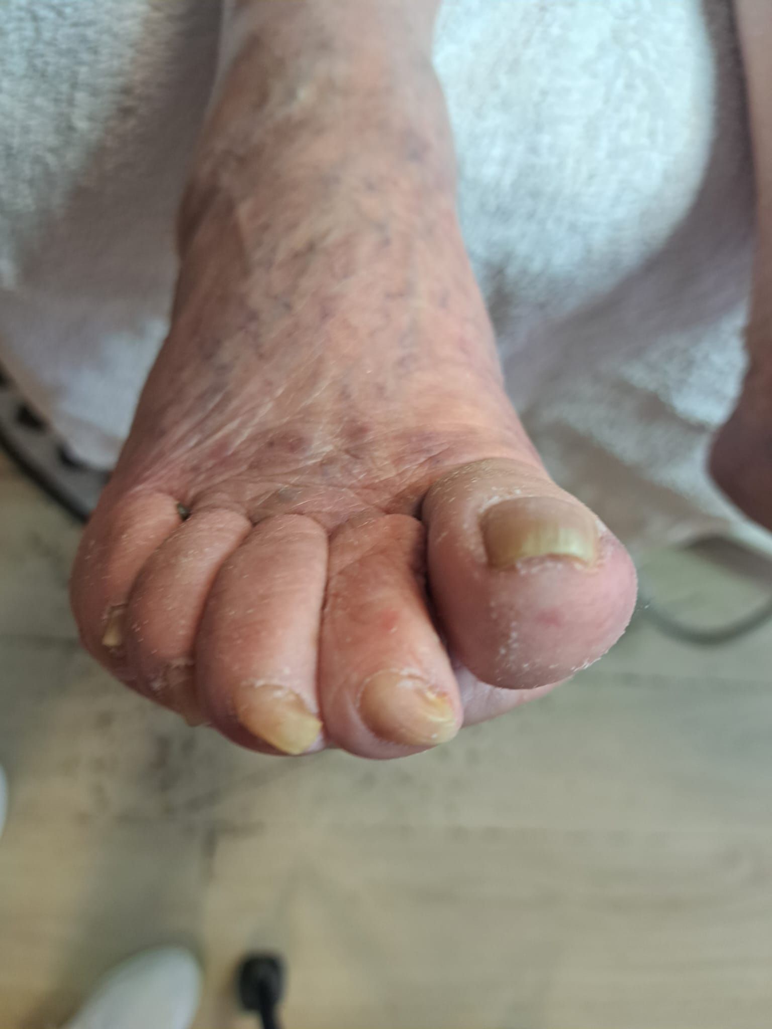 Eine Nahaufnahme vom Fuß einer Person mit einem abgebrochenen Zehennagel.