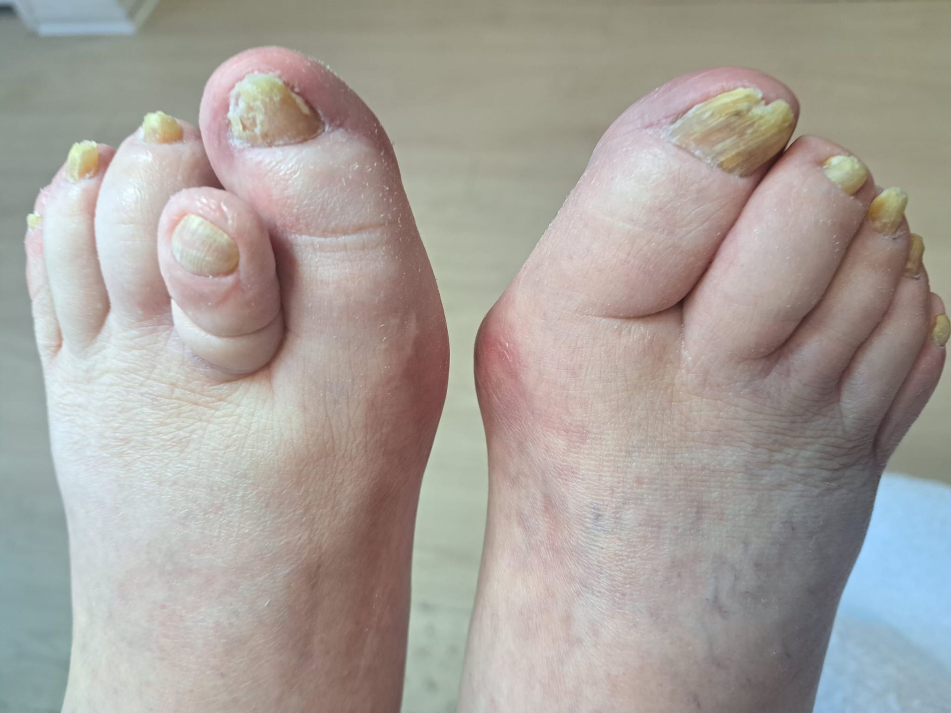 Eine Nahaufnahme der Füße einer Person mit gelben Zehennägeln.