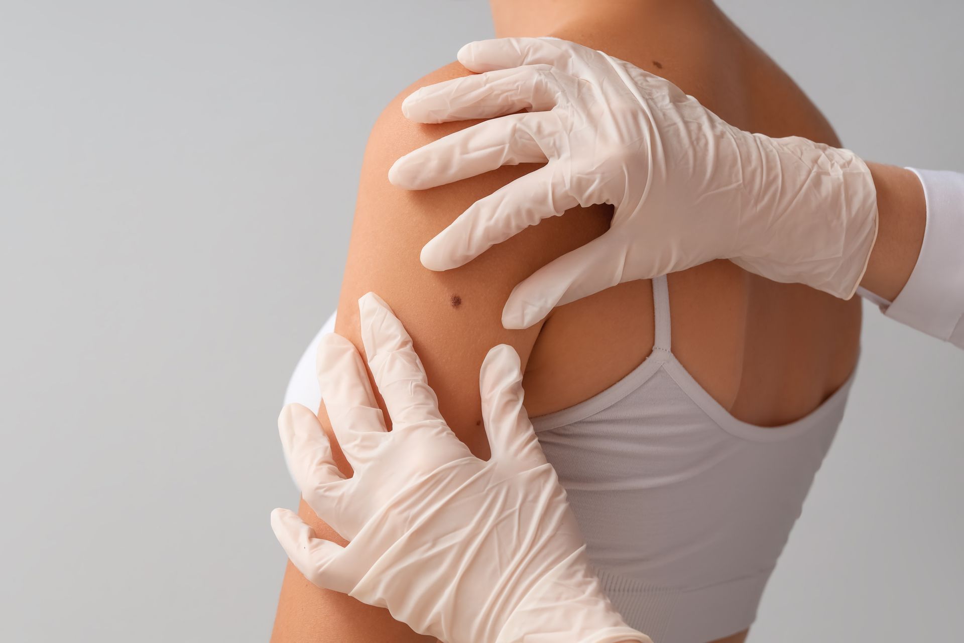 Doctor examinando un lunar en el hombro de un paciente. Con las manos enguantadas palpando la piel.