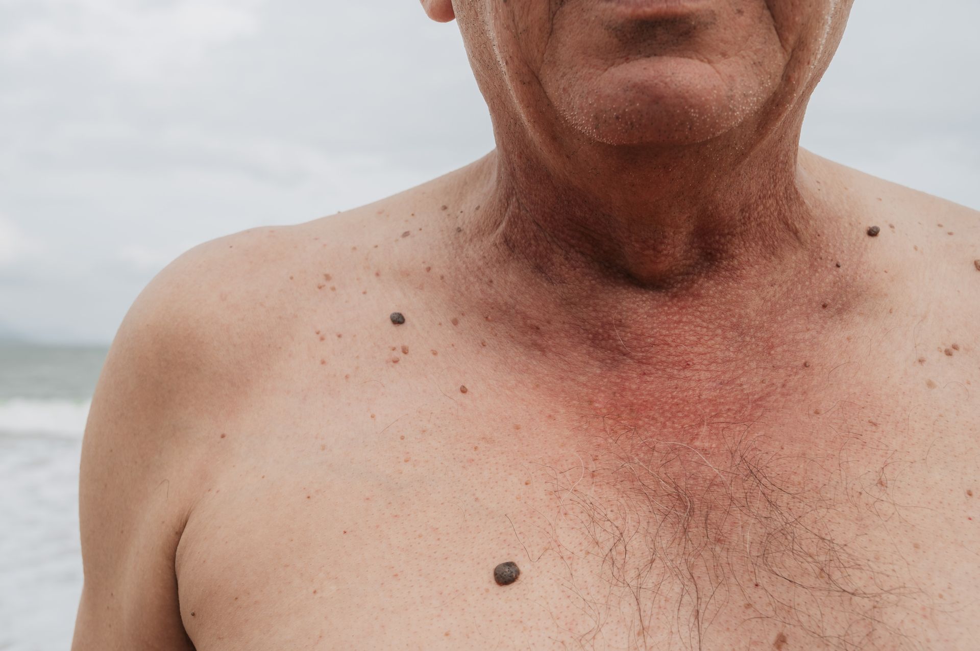 Parte superior del cuerpo de un hombre con varios lunares en el pecho y una mancha rojiza en el cuello, al aire libre.