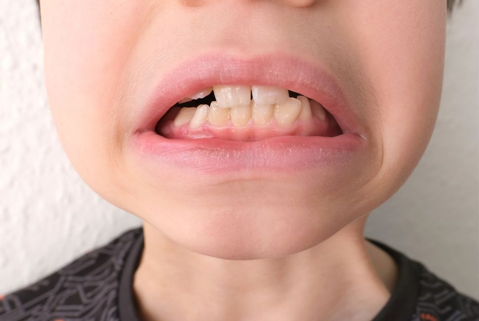 Dentition d'une petite fille avec des dents qui se chevauchent