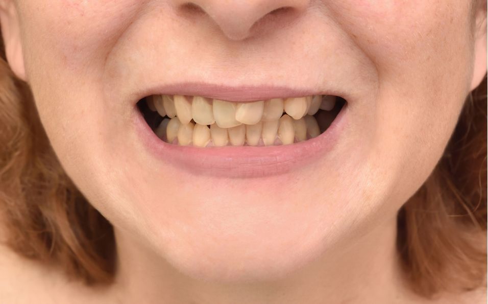 Dentition d'une jeune femme avec des dents qui se chevauchent