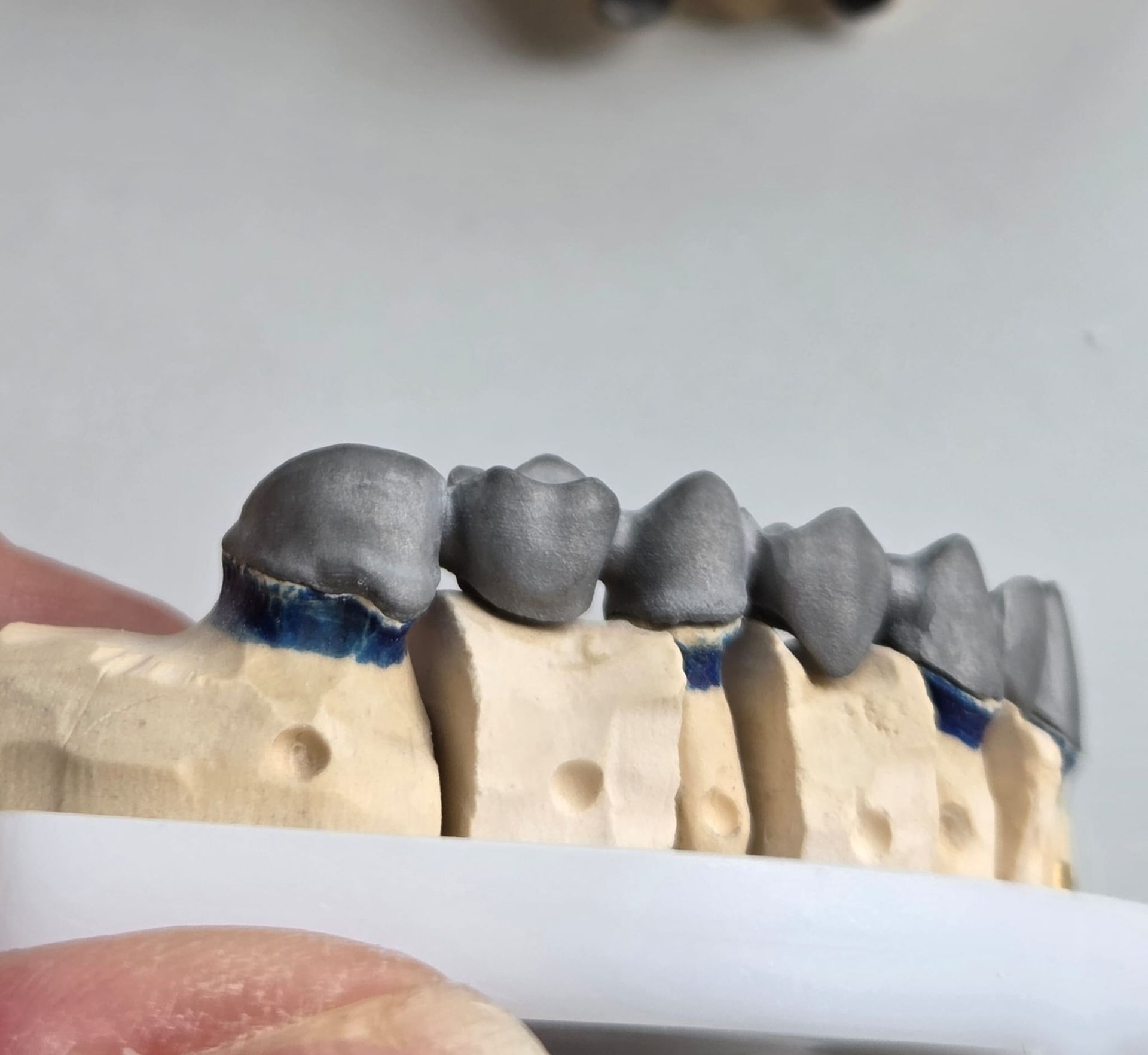 Primer plano de un modelo dental con coronas dentales grises sobre una base beige, sostenido en una mano.