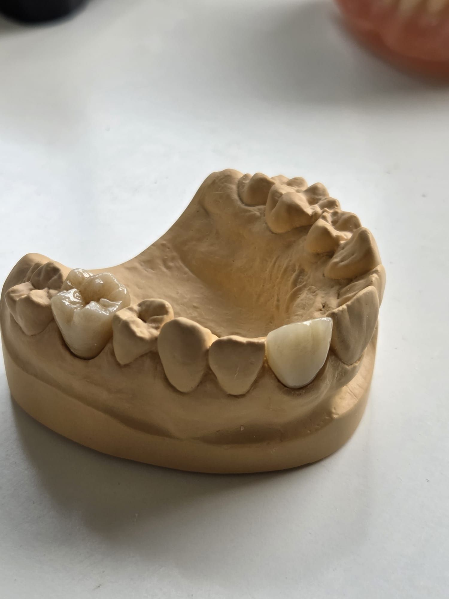 Molde dental de yeso de una mandíbula superior e inferior con dientes, sobre una superficie blanca
