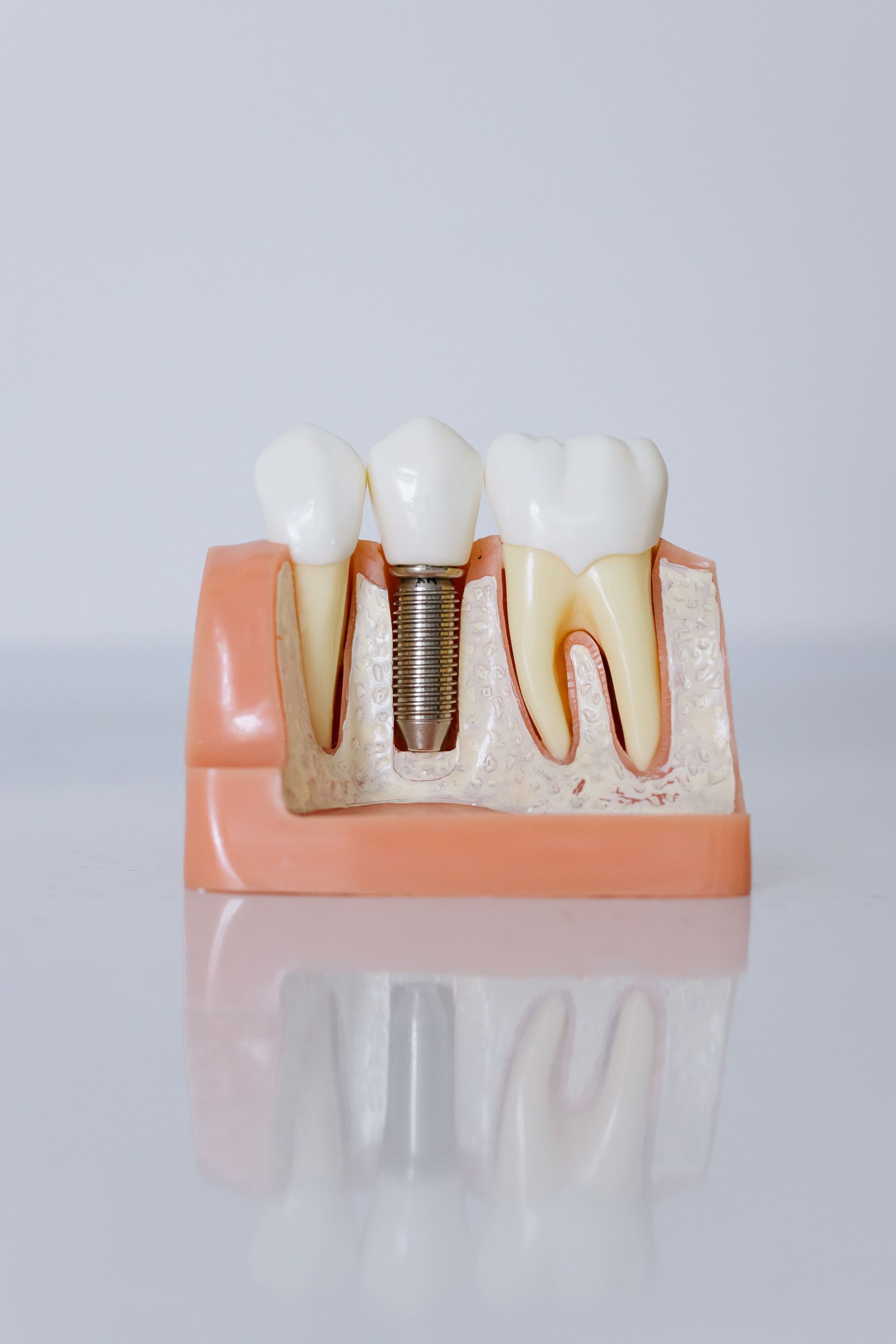 Modelo de implante dental con tres dientes, con un tornillo metálico visible en el tejido gingival rosado