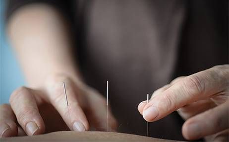 acupuncture