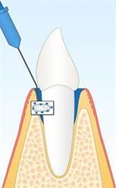 Abbildung eines Zahns mit einer Injektionsnadel in der Nähe des Zahnfleischsaums. Der Zahn ist weiß; das Zahnfleisch ist rot und blau.