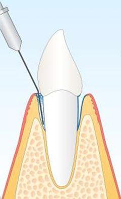 Diagramm eines Zahns und des umgebenden Zahnfleischgewebes mit einer Nadel, die ein Betäubungsmittel injiziert. Der Zahn ist weiß; das Zahnfleisch ist rot, rosa und hellbraun.