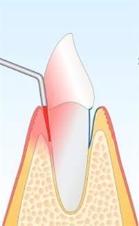 Abbildung: Zahnsteinentfernung mit einem zahnärztlichen Instrument. Gezeigt wird ein Zahn mit rotem Zahnfleisch und einer in die Tasche eingeführten Sonde.