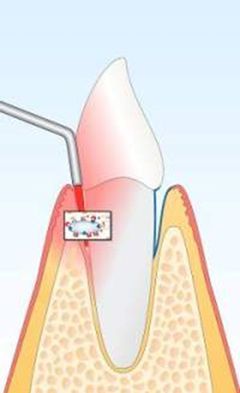 Diagramm eines Zahns, bei dem zur Behandlung des Zahnfleischs ein Laser verwendet wird, der den Prozess der Parodontalbehandlung verdeutlicht.