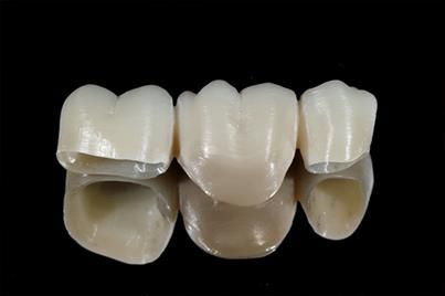 Zahnbrücke: drei künstliche Zähne in einer Reihe, darunter eine reflektierende Oberfläche.